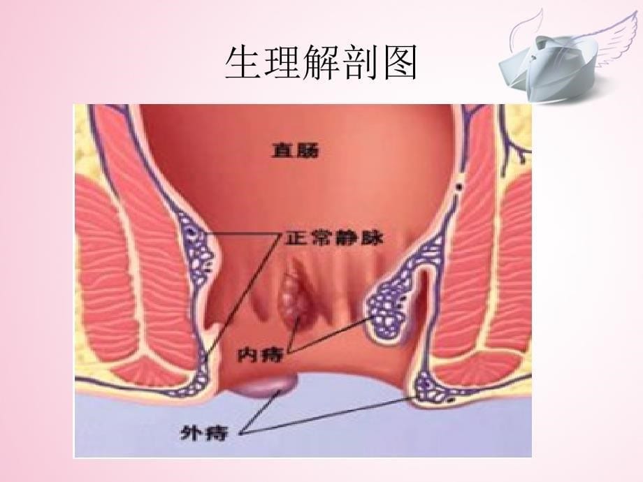 混合痔查房_第5页