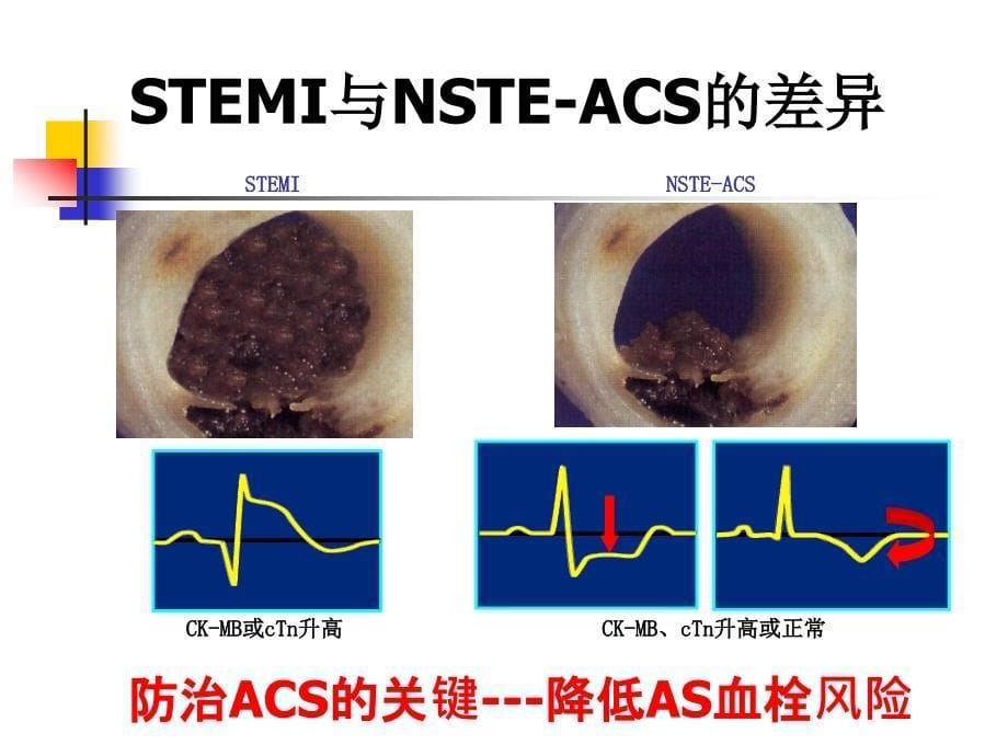 ACS中比伐卢定能取代肝素吗_第5页