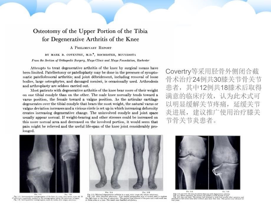 保膝治疗之胫骨高位截骨术_第5页