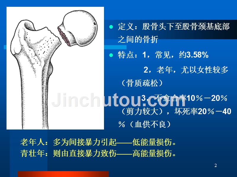 股骨颈骨折陈雪_第2页
