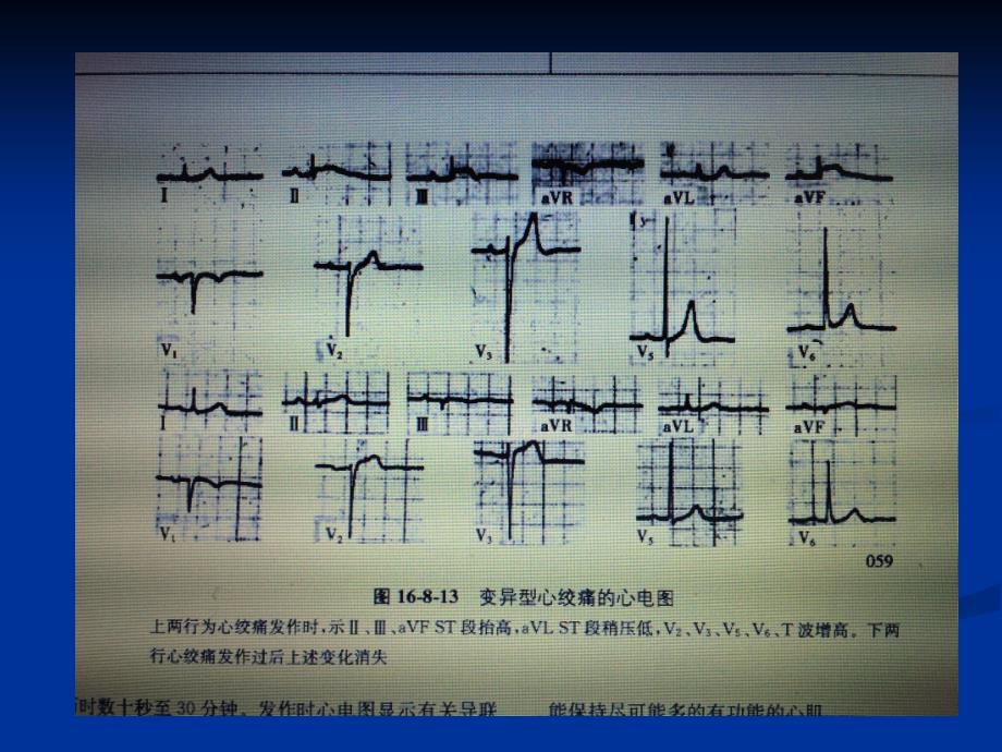 冠脉痉挛综合征_第3页