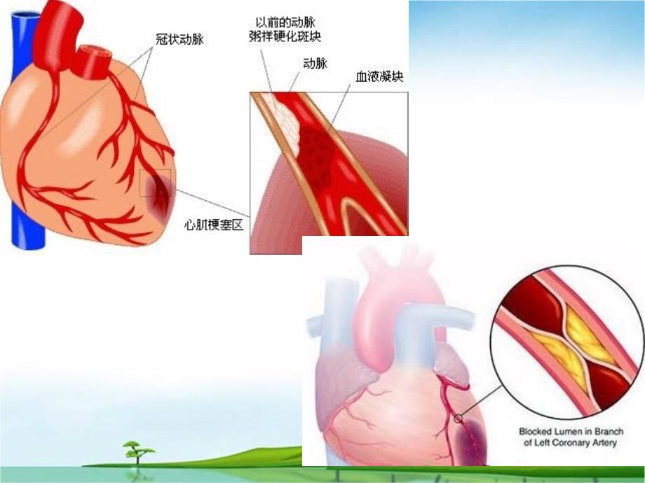 ACS急性冠脉综合症的表现与护理_第3页