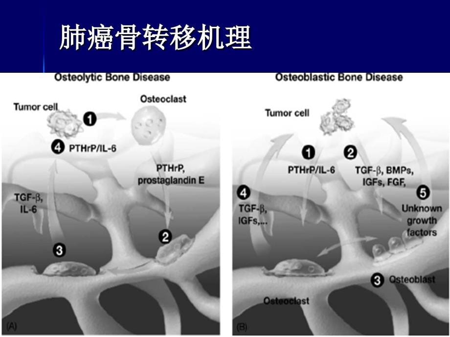 肺癌骨转移治疗_第5页