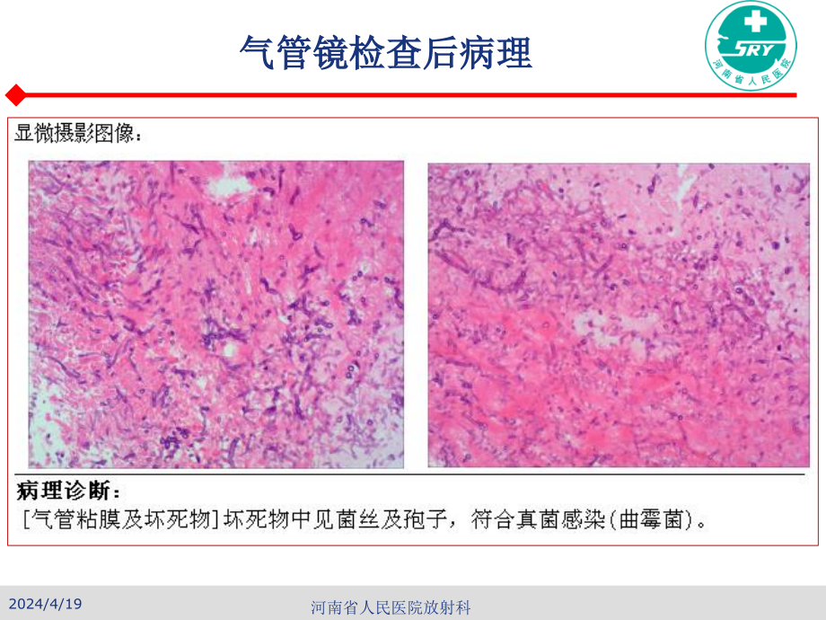 曲霉菌病的诊断_第3页