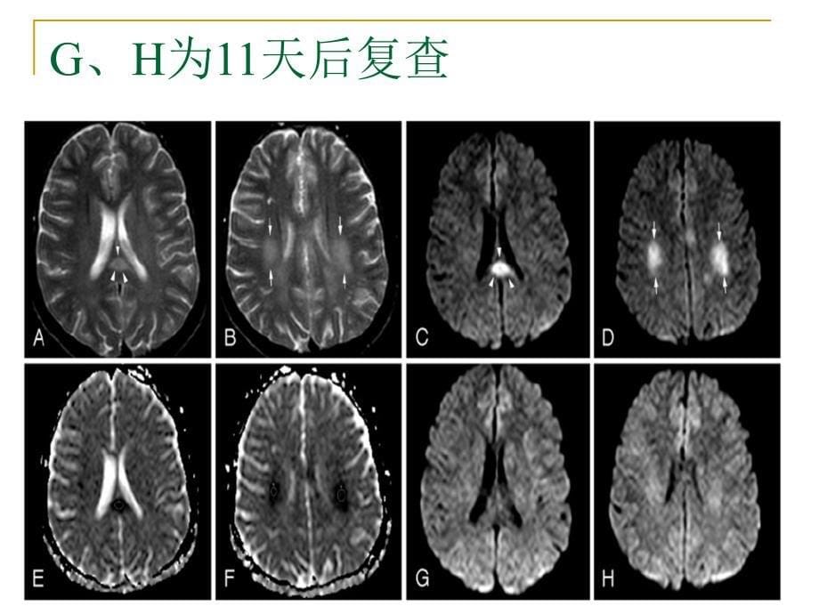 可逆性胼胝体压部综合症_第5页