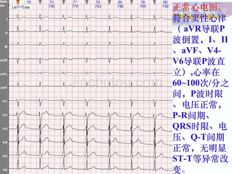 常见心电图诊断-实习生进修生教案之二_第4页