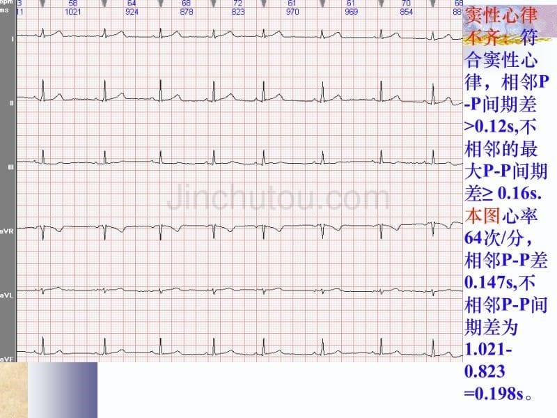 常见心电图诊断-实习生进修生教案之二_第5页