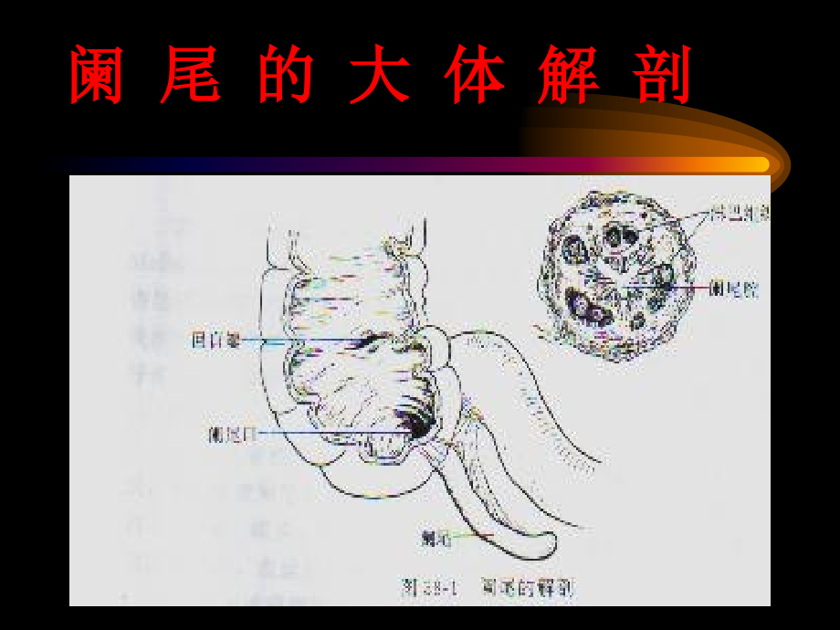 阑尾炎教学_第2页