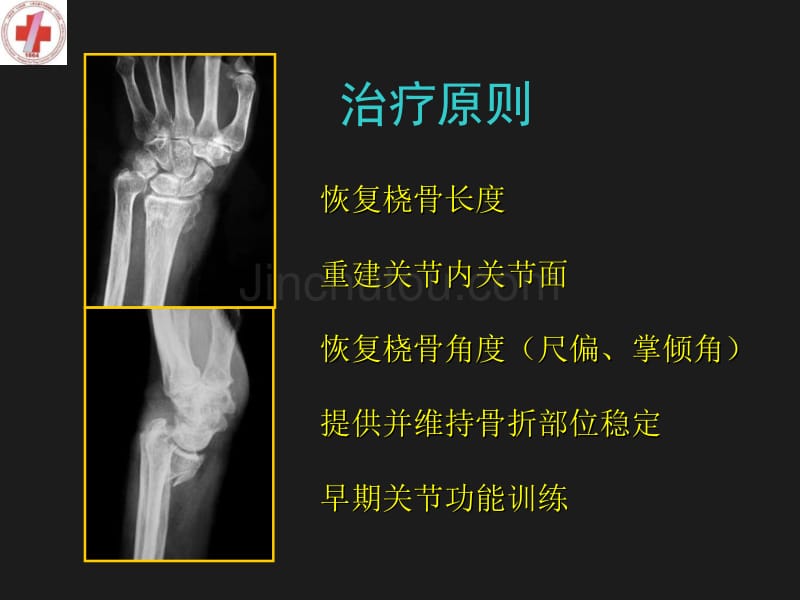 应用桡骨远端掌侧锁定接骨板治疗背侧移位骨折_第4页