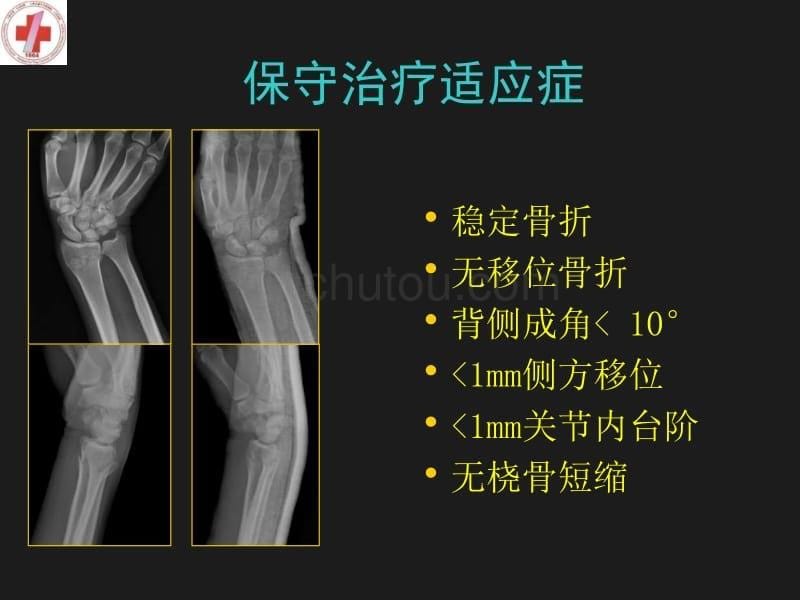 应用桡骨远端掌侧锁定接骨板治疗背侧移位骨折_第5页