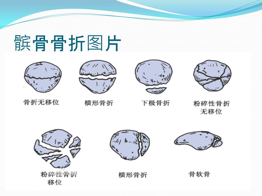 髌骨骨折的护理_第4页