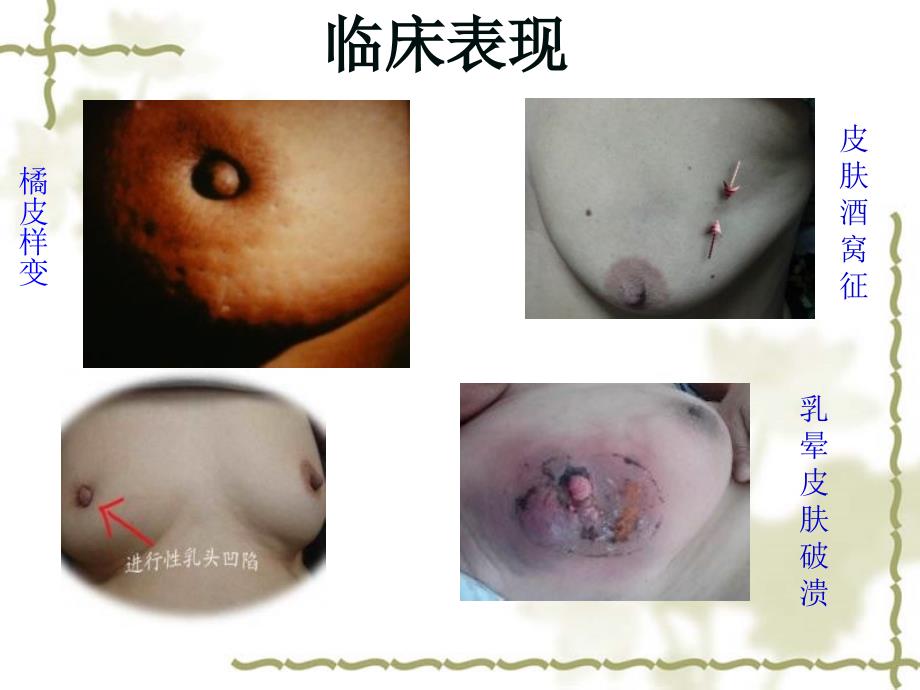 乳腺癌术后化疗后护理教学查房_第4页