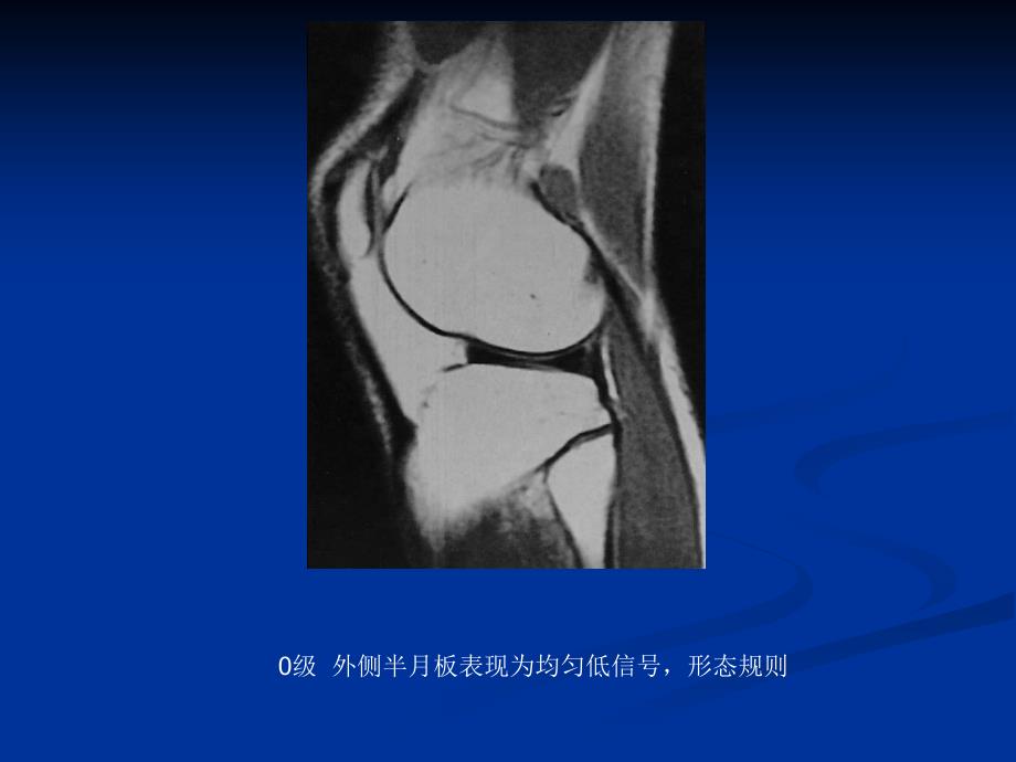膝关节半月板损伤MRI_第1页