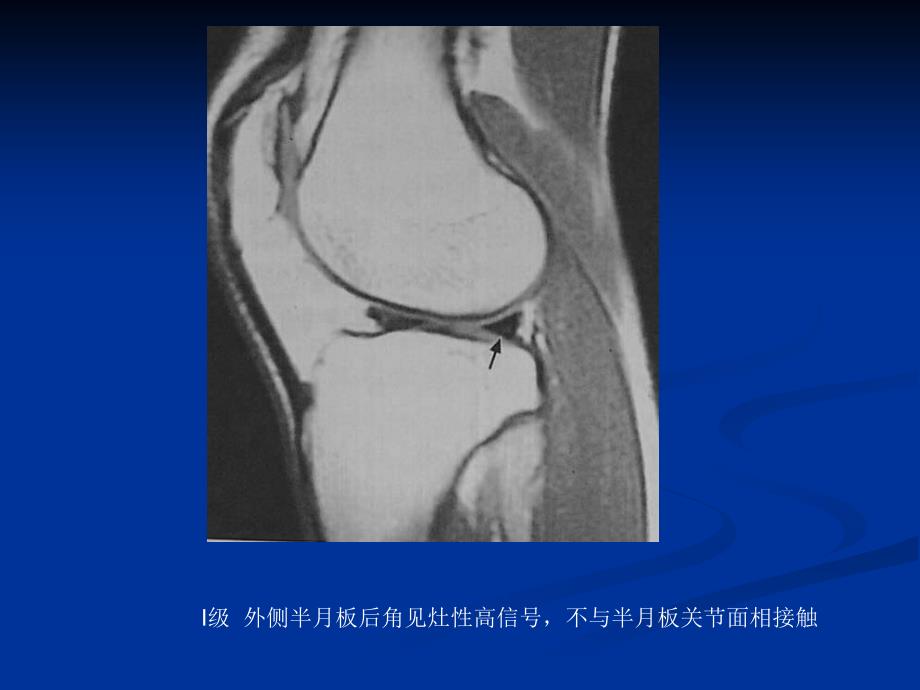 膝关节半月板损伤MRI_第2页