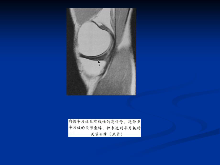 膝关节半月板损伤MRI_第3页