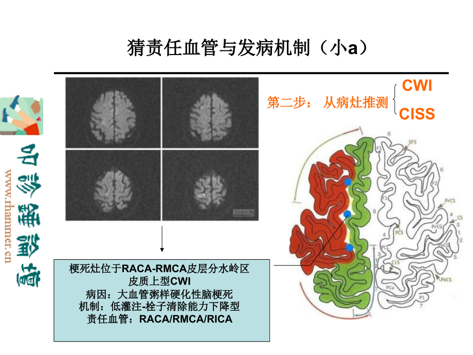 从影像学梗死部位推测责任供血血管_第4页