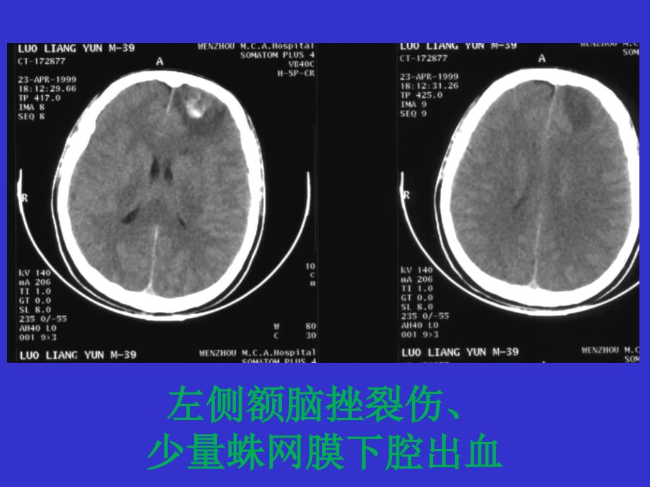 部分常见疾病CT影像_第4页