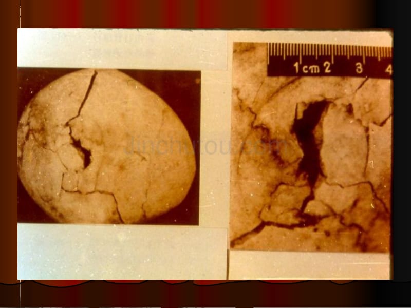 ·法医病理学损伤死因推断_第5页