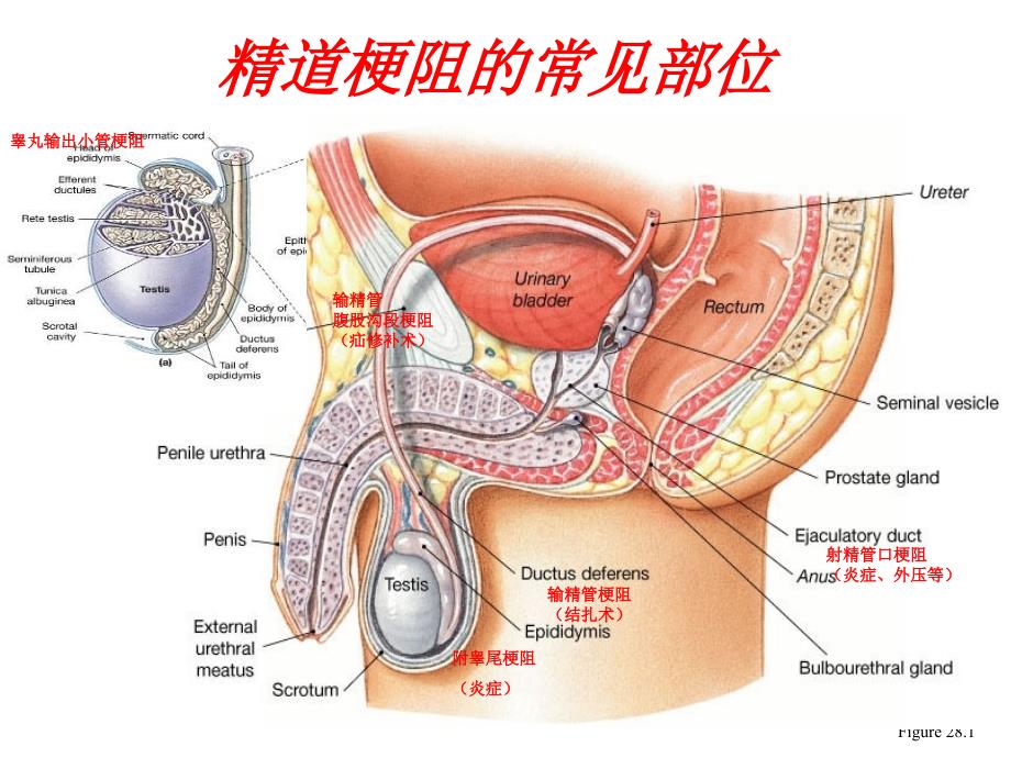 梗阻性无精子症的治疗_第3页