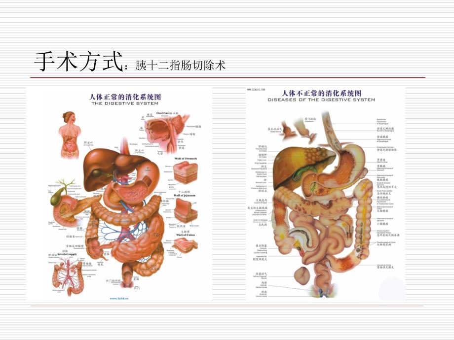 胰十二指肠手术的护理查房_第4页