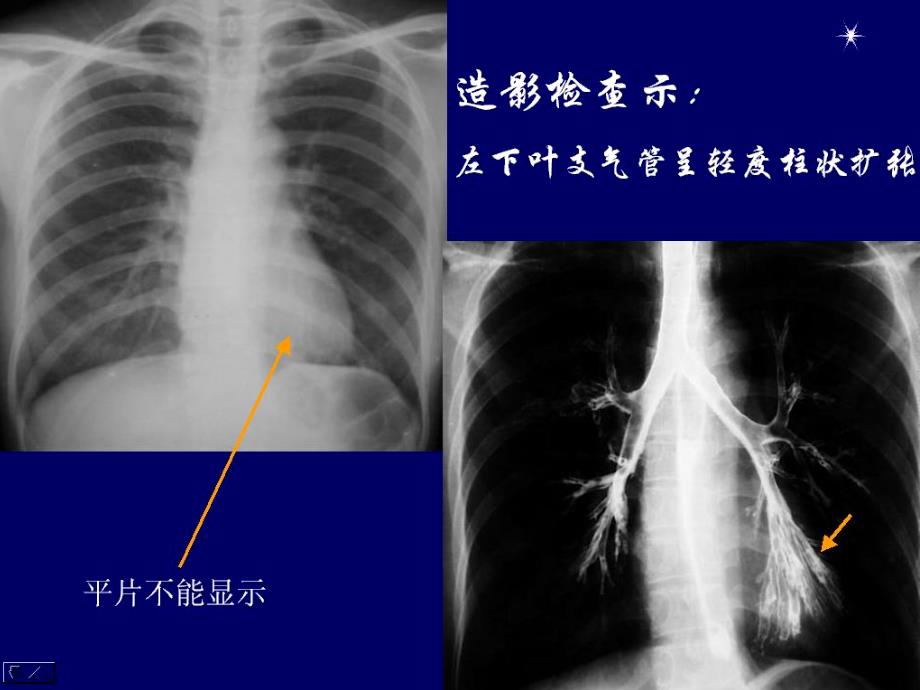 呼吸系统炎性疾病影像学诊断_第4页