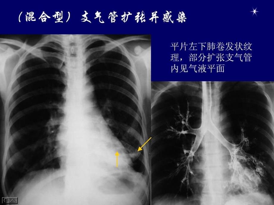 呼吸系统炎性疾病影像学诊断_第5页