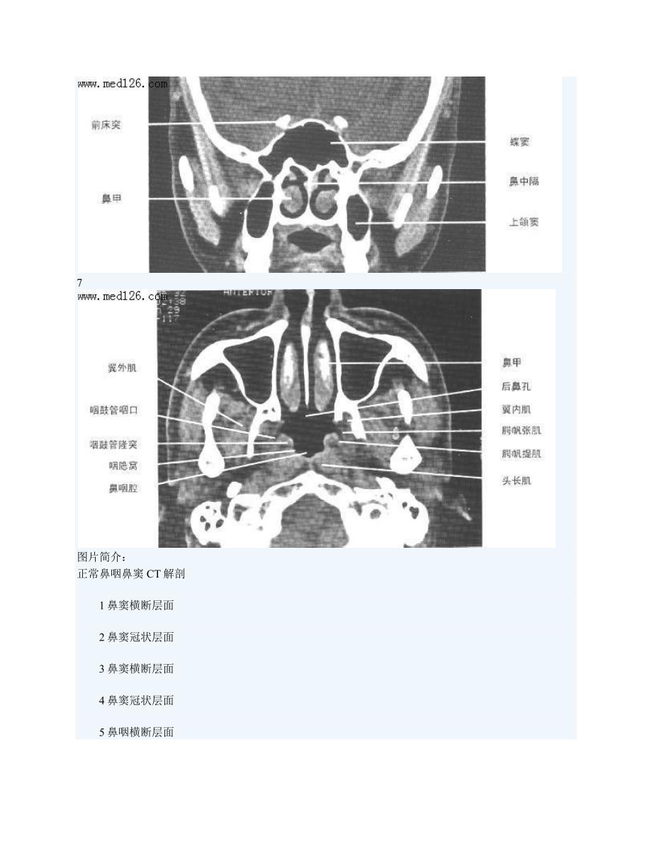 正常鼻咽鼻窦ct解剖_第3页