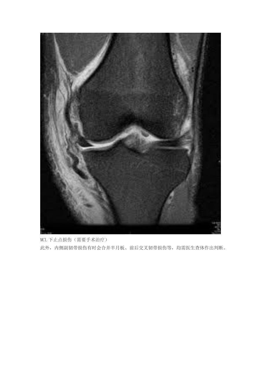 内侧副韧带上止点或实质部损伤-及时处理避免手术(3)_第5页