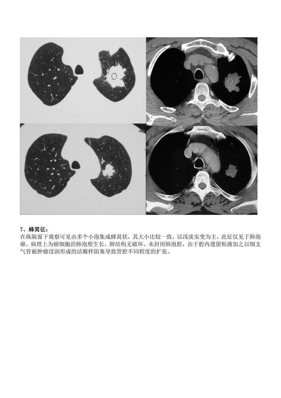 胸部医学影像征象集萃_第5页