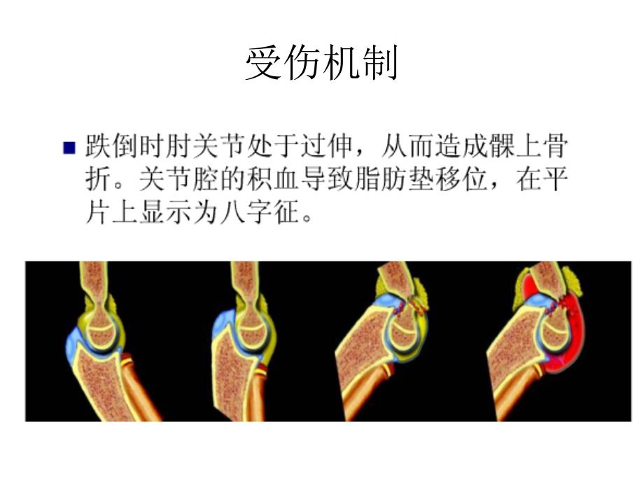 小儿肘关节外伤课件_第2页