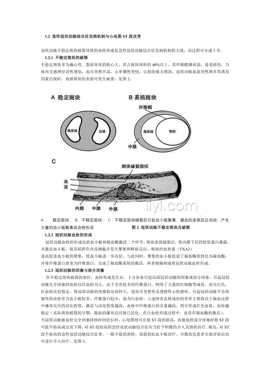 急性冠状动脉综合征心电图—郭继鸿_第2页