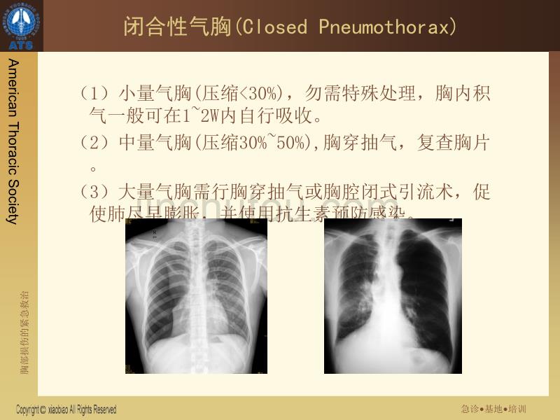 血气胸的紧急救治_第5页