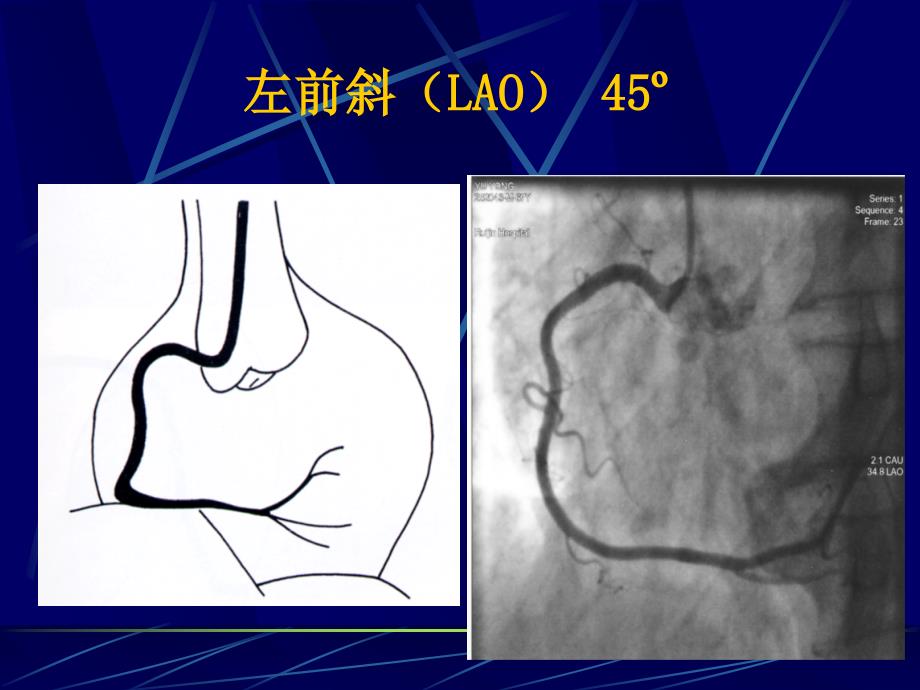 右冠状动脉常用投照体位_第2页