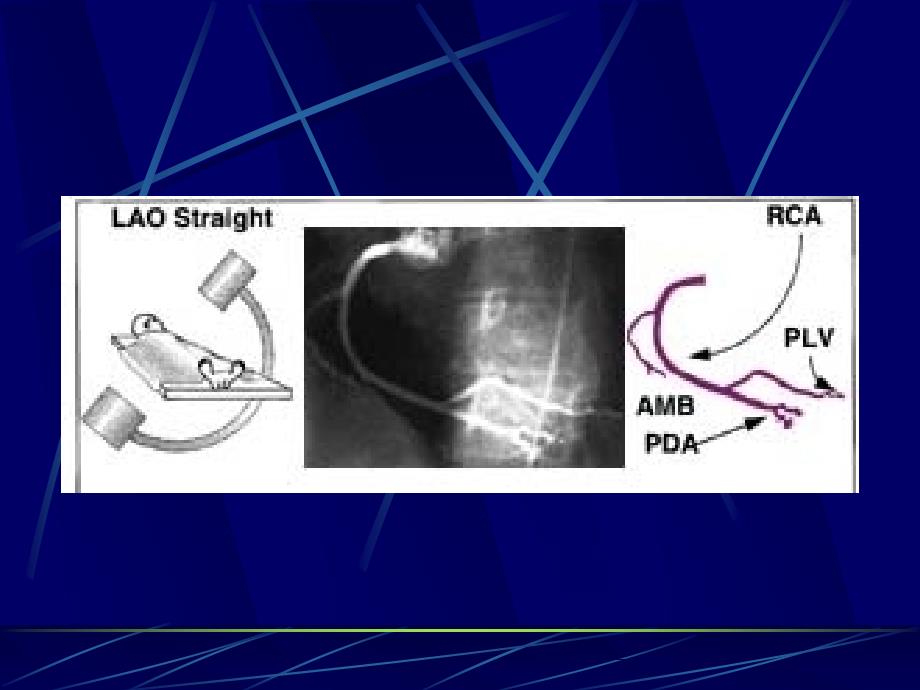 右冠状动脉常用投照体位_第3页
