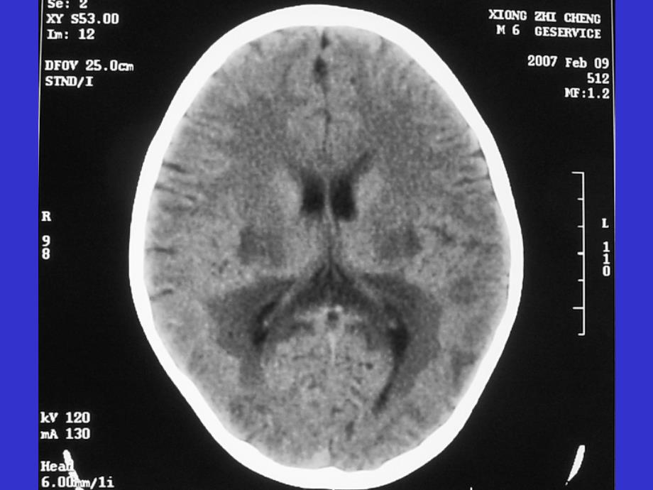 常见脑白质病影像医学课件_第4页