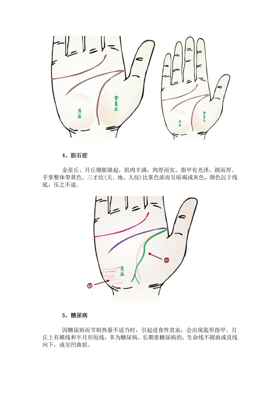 24种手相揭示身心健康问题_第3页