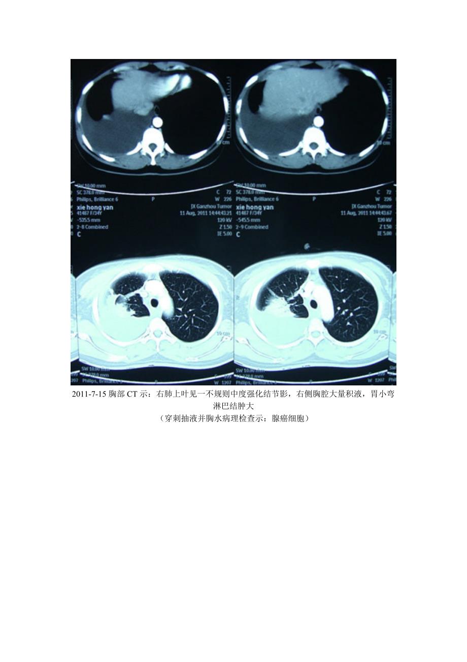 癌性胸腔积液临床案例剖析1_第3页