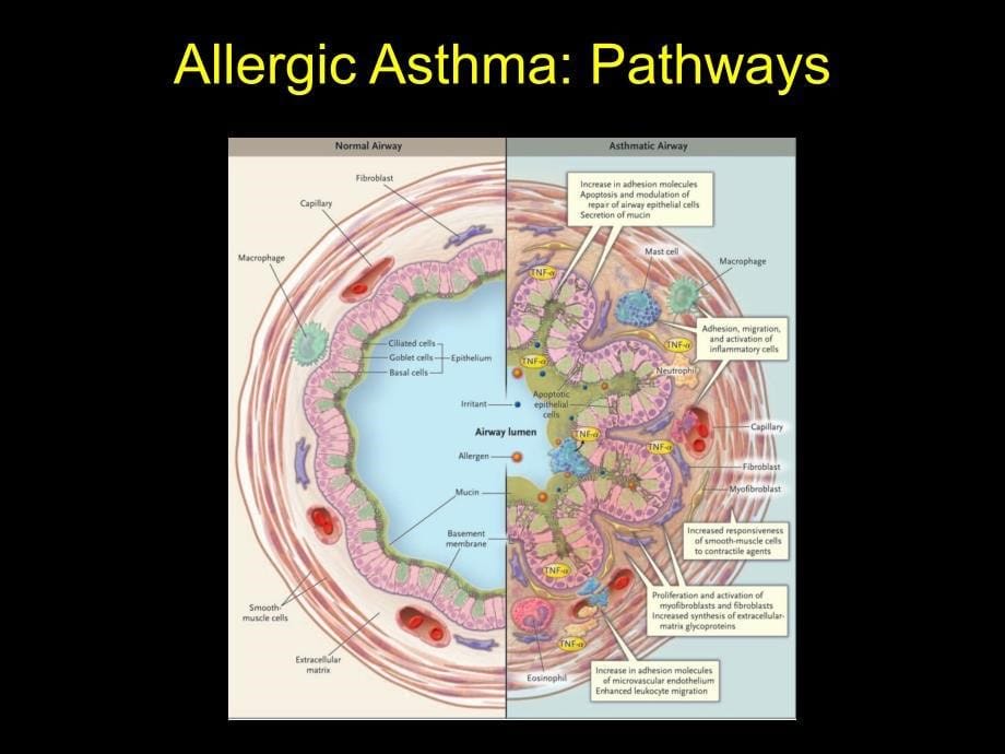 哮喘免疫表型（Asthma Immune Phenotypes）课件_第5页