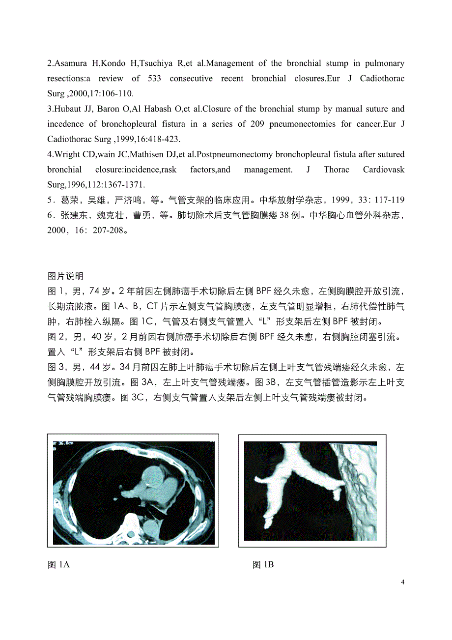 肺切除术后支气管胸膜瘘的支架治疗_第4页