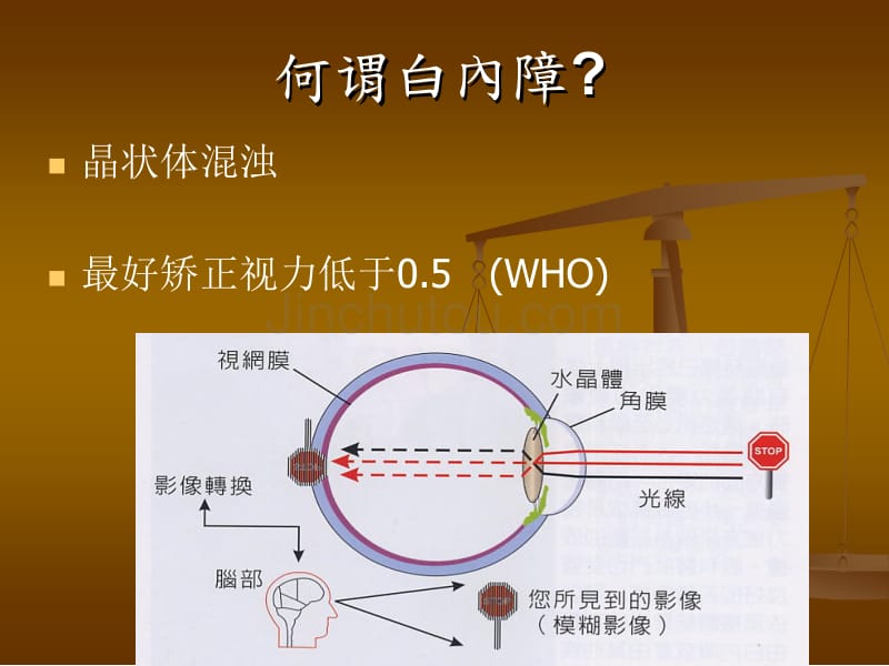 白内障成因及治疗_第5页