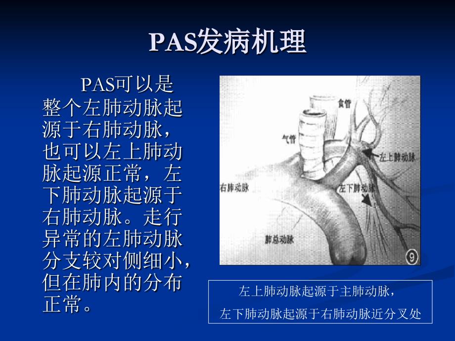 肺动脉吊带的影像学表现_第3页