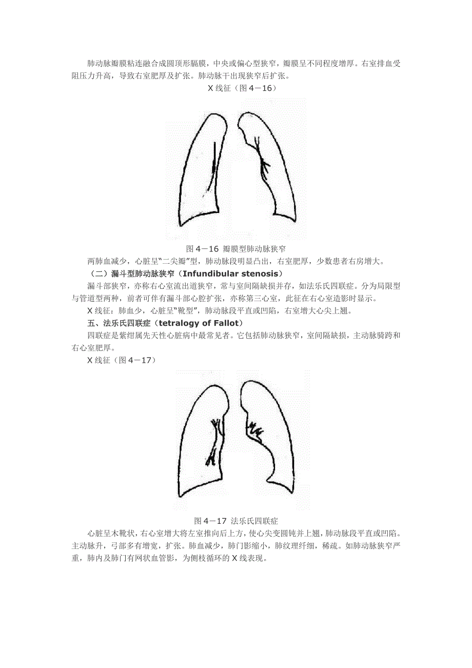 常见先心病的x线表现_第3页