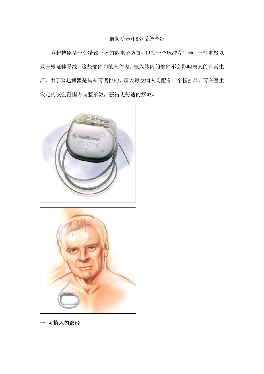 脑起搏器系统的介绍_第1页