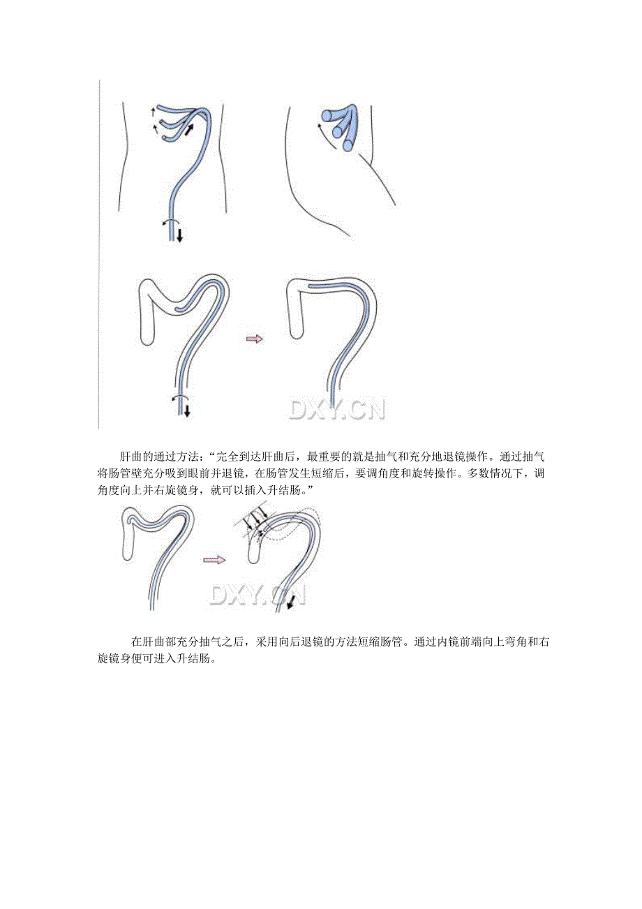 单人肠镜初学者的操作体会交流_第4页