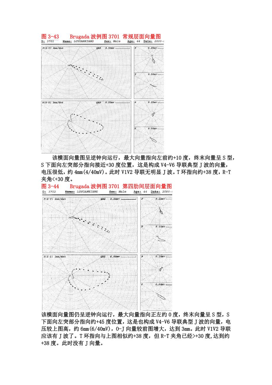 有关早复征、室上嵴图形与brugada波的有关问题_第4页