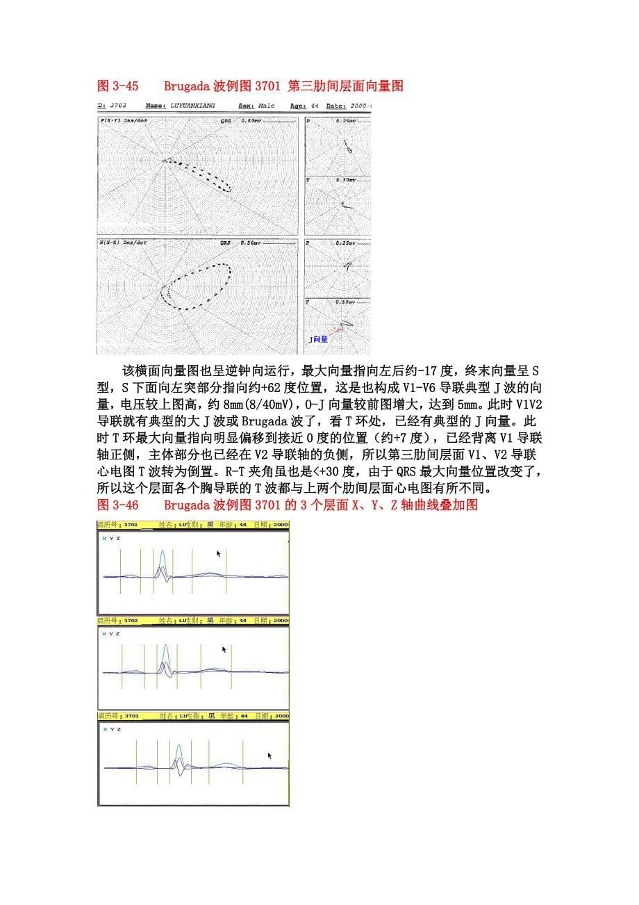 有关早复征、室上嵴图形与brugada波的有关问题_第5页