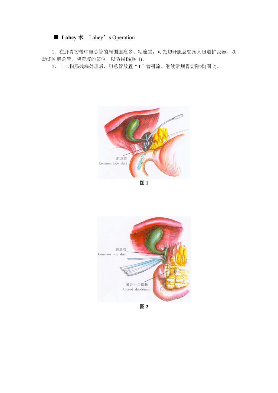 胃、十二指肠溃疡切除的非常规术式_第4页
