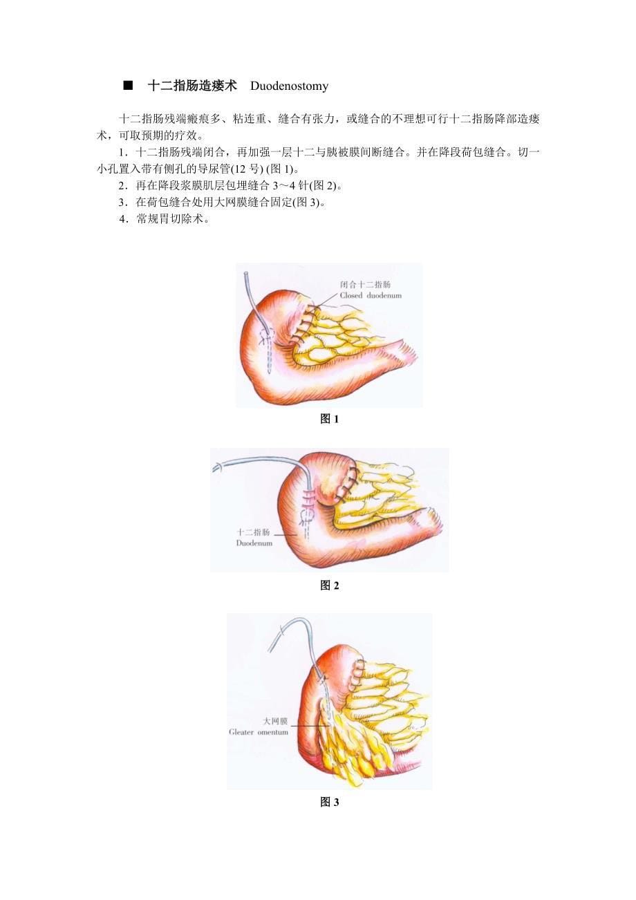胃、十二指肠溃疡切除的非常规术式_第5页