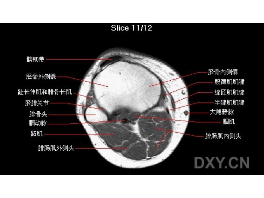 膝部MRI解剖基础医学课件_第2页