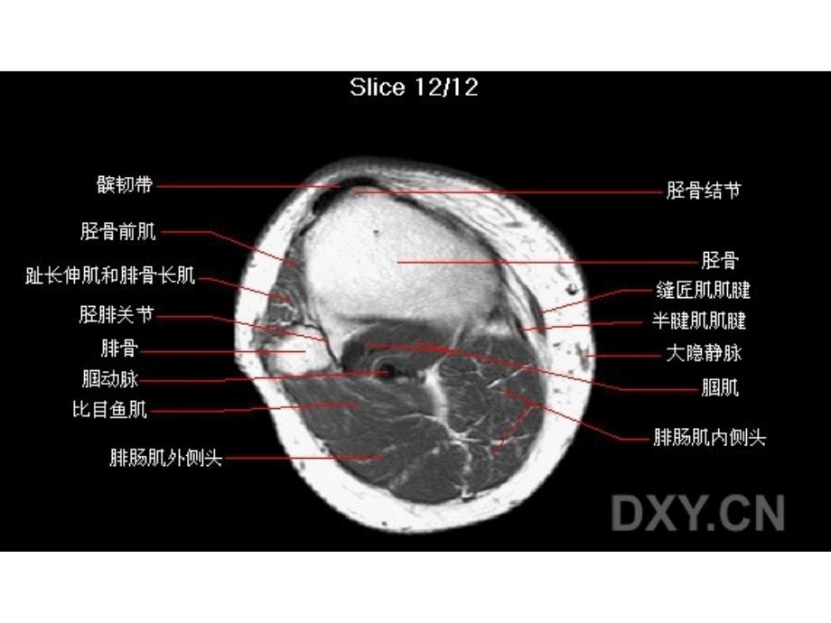 膝部MRI解剖基础医学课件_第4页